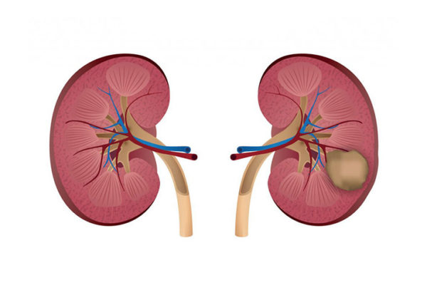 Tumor renal